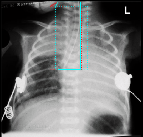 Chest X-ray with ROI